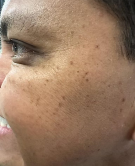 iVesselbar Botox Crow’s Feet 2 After Botox Neurotoxins