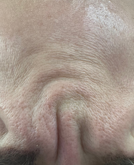 iVesselbar Forehead Botox 1 Before Botox Neurotoxins
