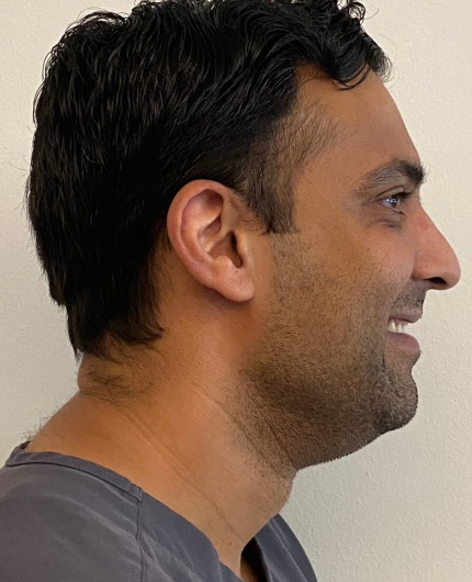 iVesselbar Kybella 1 Before Kybella Double Chin Fat Removal