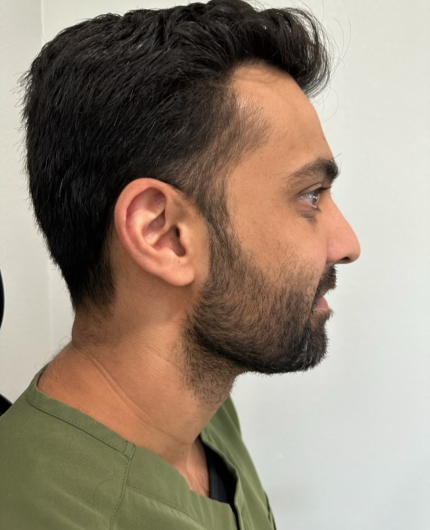 iVesselbar Kybella 2 After Kybella Double Chin Fat Removal