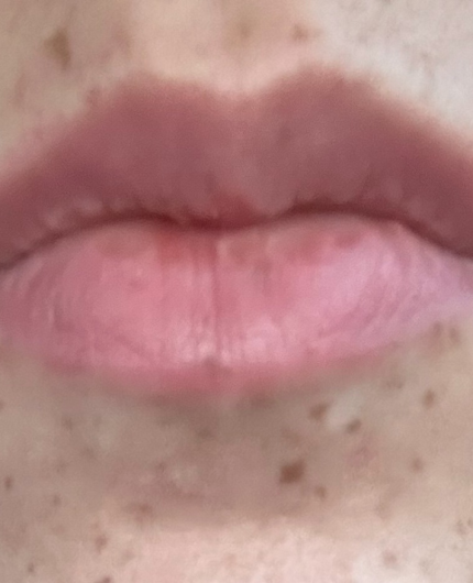iVesselbar Lip Flip 2 After Lip Flip