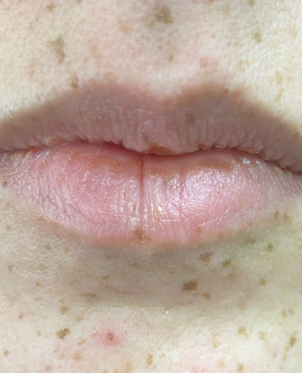 iVesselbar Lip Flip 1 Before Lip Flip