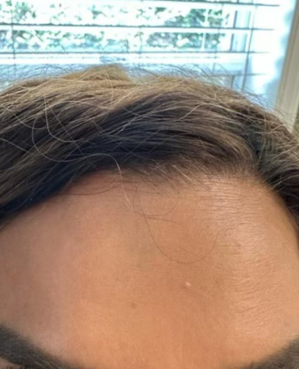 iVesselbar Jeuveau 2 After Botox Neurotoxins
