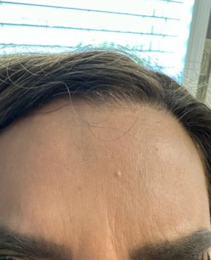 iVesselbar Jeuveau 1 Before Botox Neurotoxins