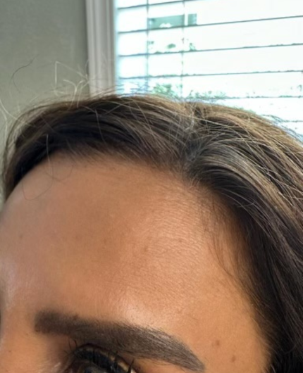 iVesselbar Microneedling 2 After Microneedling